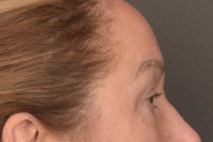 Brow Lift Before & After Patient #3917