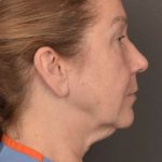 Facial Fat Grafting Before & After Patient #3918
