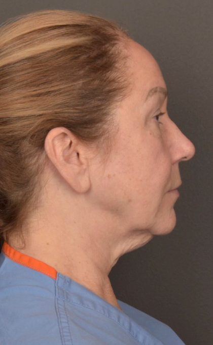 Facelift Before & After Patient #3914