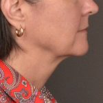 Neck Lift Before & After Patient #3962