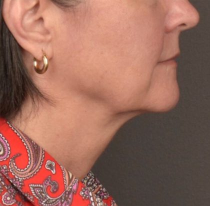 Neck Lift Before & After Patient #3962