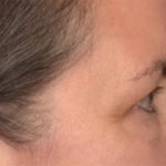 Blepharoplasty Before & After Patient #3963