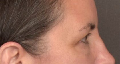 Blepharoplasty Before & After Patient #3963