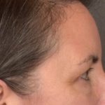 Brow Lift Before & After Patient #3964