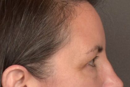 Brow Lift Before & After Patient #3964