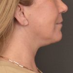 Neck Lift Before & After Patient #3915