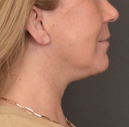 Neck Lift Before & After Patient #3915