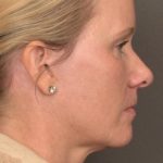 Facelift Before & After Patient #4014