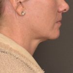 Neck Lift Before & After Patient #4015