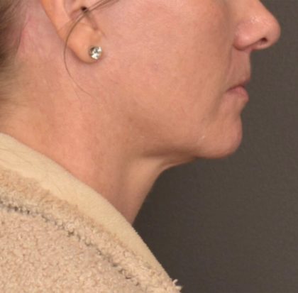 Neck Lift Before & After Patient #4015