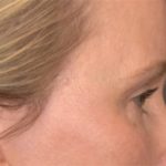 Blepharoplasty Before & After Patient #4016