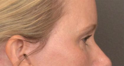 Blepharoplasty Before & After Patient #4016