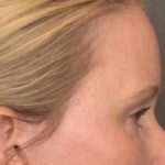 Brow Lift Before & After Patient #4017