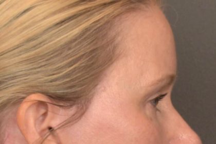 Brow Lift Before & After Patient #4017