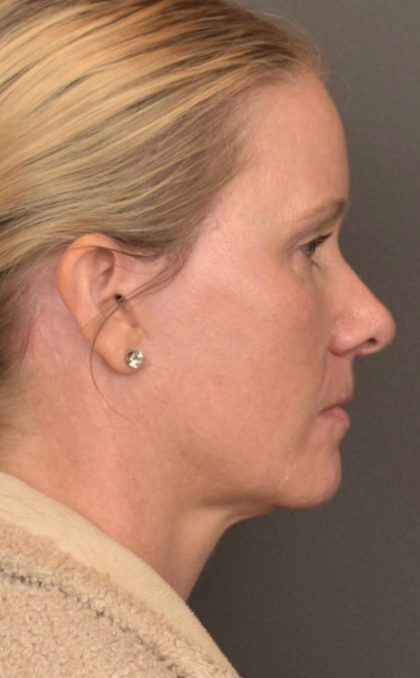 Facial Fat Grafting Before & After Patient #4018