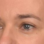 Blepharoplasty Before & After Patient #4059