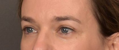 Blepharoplasty Before & After Patient #4059