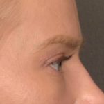 Blepharoplasty Before & After Patient #4074