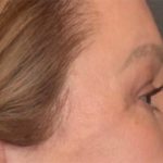 Blepharoplasty Before & After Patient #3916