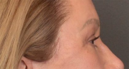 Blepharoplasty Before & After Patient #3916
