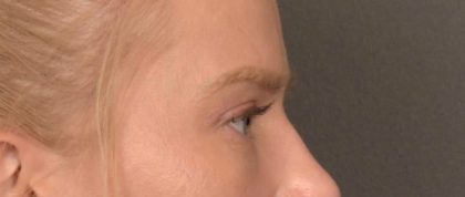 Brow Lift Before & After Patient #4075