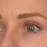 Brow Lift Before & After Patient #4095