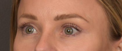 Facial Fat Grafting Before & After Patient #4096