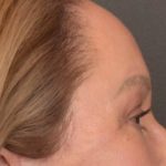 Brow Lift Before & After Patient #3917