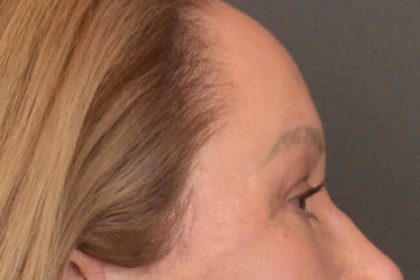 Brow Lift Before & After Patient #3917