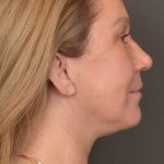 Facial Fat Grafting Before & After Patient #3918