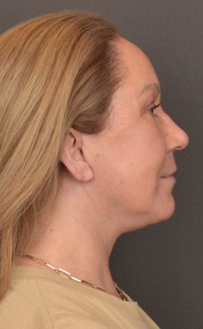 Facelift Before & After Patient #3914