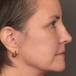 Facelift Before & After Patient #3961