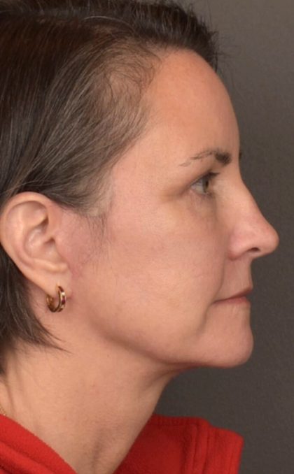 Facelift Before & After Patient #3961