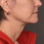 Neck Lift Before & After Patient #3962