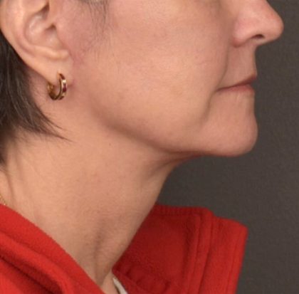 Neck Lift Before & After Patient #3962
