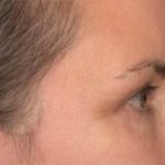 Blepharoplasty Before & After Patient #3963