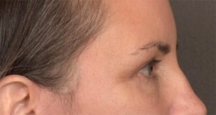 Blepharoplasty Before & After Patient #3963