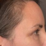 Brow Lift Before & After Patient #3964