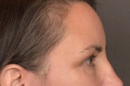 Brow Lift Before & After Patient #3964