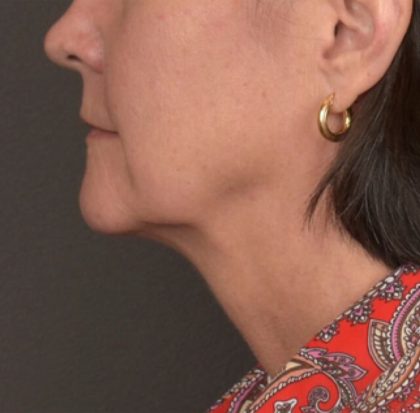 Neck Lift Before & After Patient #3962
