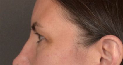 Blepharoplasty Before & After Patient #3963
