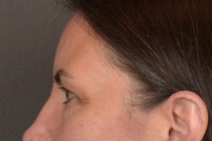 Brow Lift Before & After Patient #3964