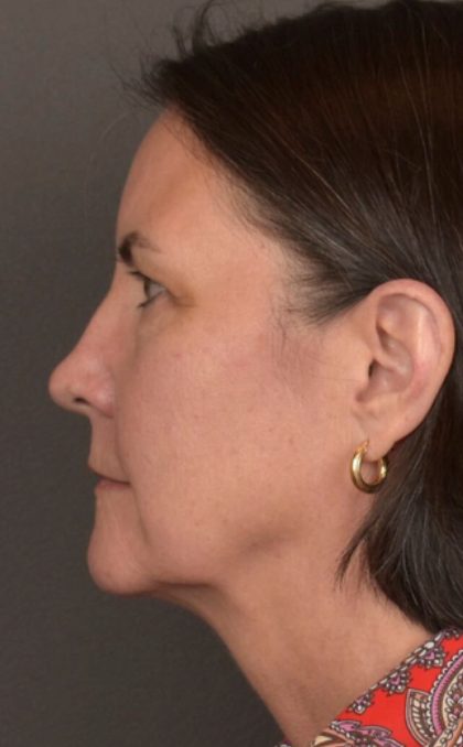 Facial Fat Grafting Before & After Patient #3965