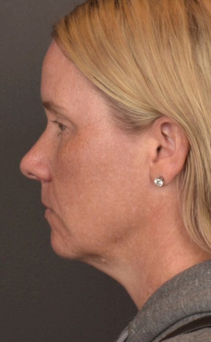 Facelift Before & After Patient #4014