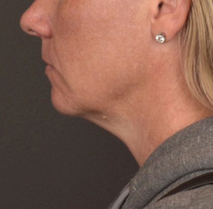 Neck Lift Before & After Patient #4015