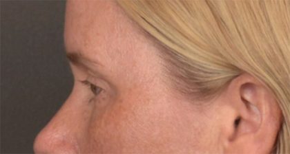 Blepharoplasty Before & After Patient #4016
