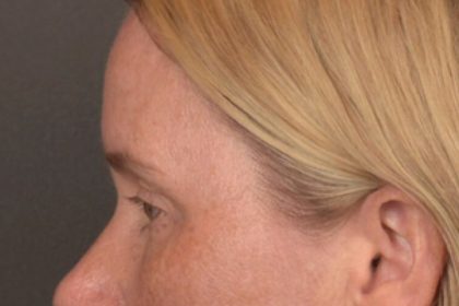 Brow Lift Before & After Patient #4017