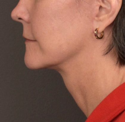Neck Lift Before & After Patient #3962