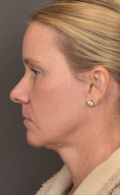 Facial Fat Grafting Before & After Patient #4018