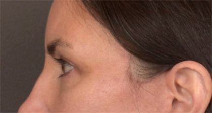 Blepharoplasty Before & After Patient #3963